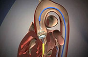 Cursos Cardiologia Intervencionista