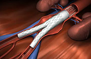 Cirugia Endovascular